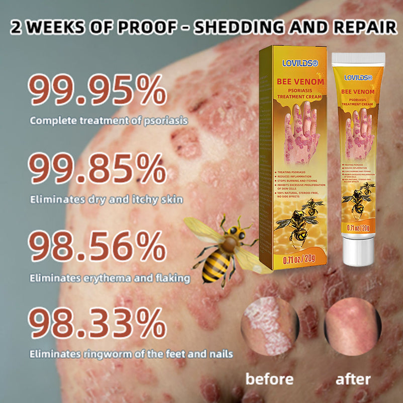 LOVILDS® Bee Venom Psoriasis Treatment Cream(Suitable for all skin conditions)